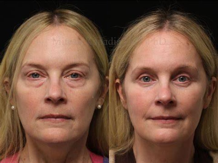 Adele’s Before and After Surgery Photos Show Proof of the Singer’s