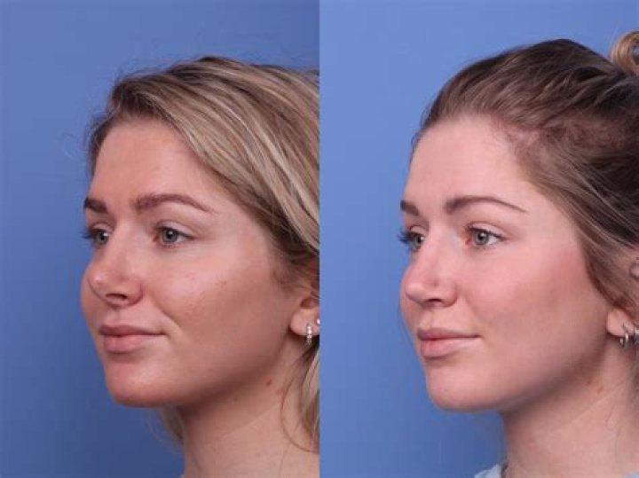 Casey Anthony Plastic Surgery Before And After Photo Chef Babyna