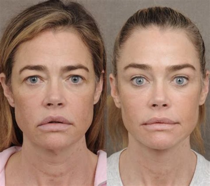 Denise Richards BEFORE and AFTER 2019
