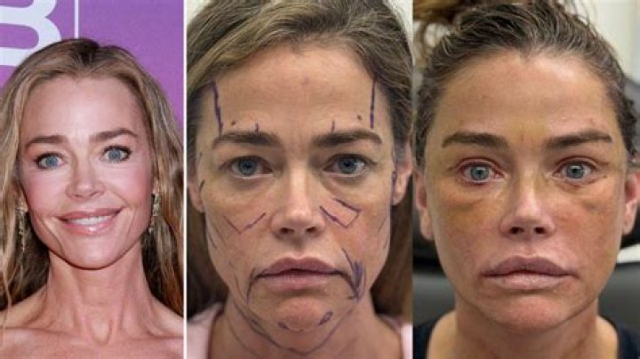 Denise Richards Plastic Surgery Breast Augmentation, Botox, Lip Filler