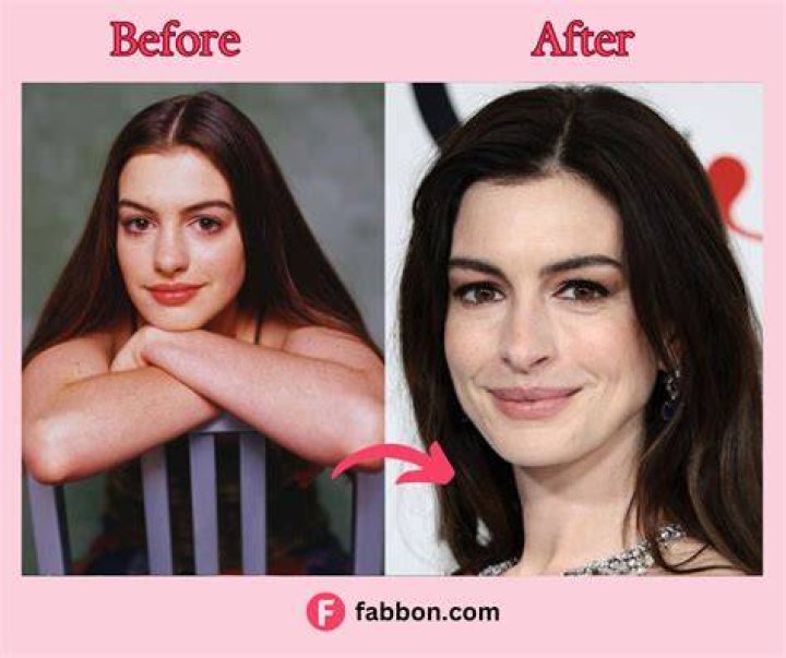 Has Anne Hathaway Undergone Plastic Surgery? See Her Transformation