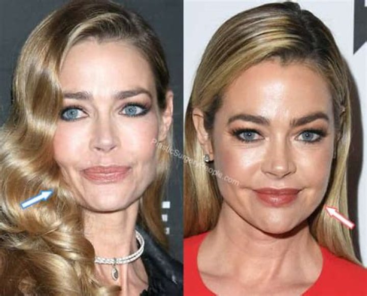 Has Denise Richards Had Botox, Fillers, Plastic Surgery?