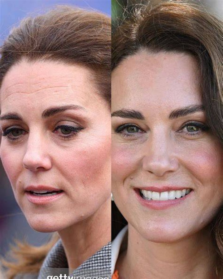 Kate Middleton Before and After Plastic Surgery Face, Body
