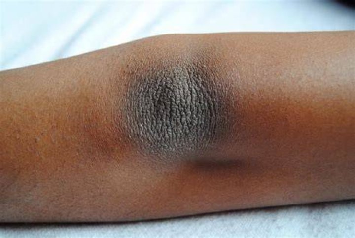 No More Dark Ashy Knees and Elbows!