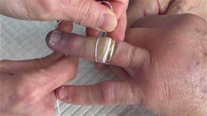 removing a ring with dental floss Yahoo Image Search Results Tip Of