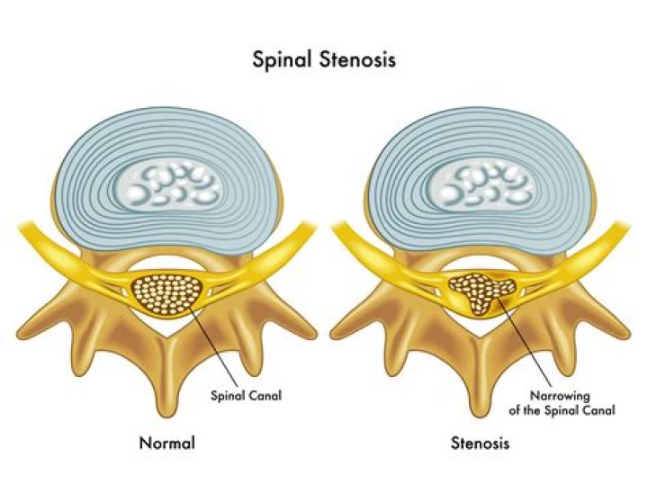Spine Anatomy Spinal Stenosis